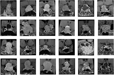 Deep Learning for Prediction of Progression and Recurrence in Nonfunctioning Pituitary Macroadenomas: Combination of Clinical and MRI Features